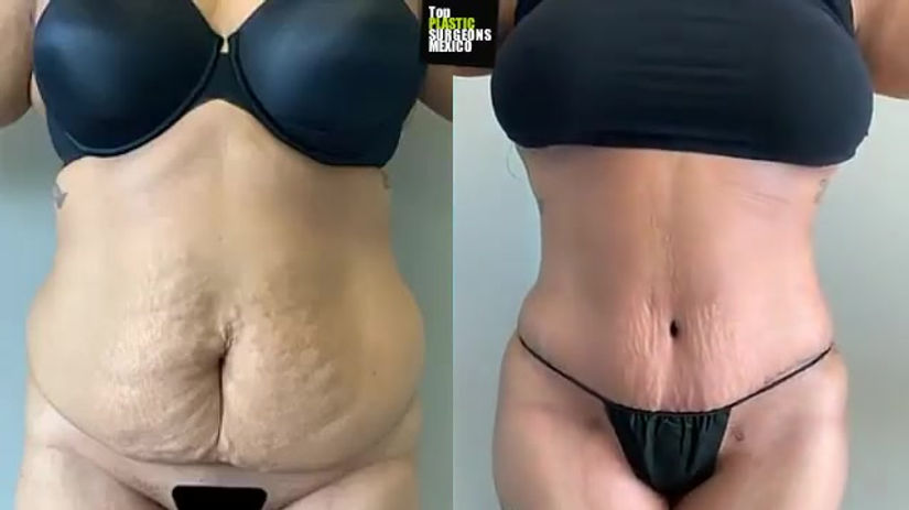 TUMMY TUCK + 360°LIPO